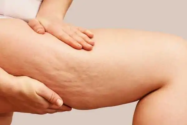 Image of woman showing leg with cellulite Ledbury