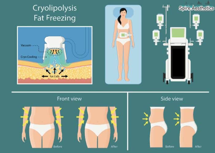 Image of diet and fat freezing combined for best results for Spire Aesthetics Ledbury