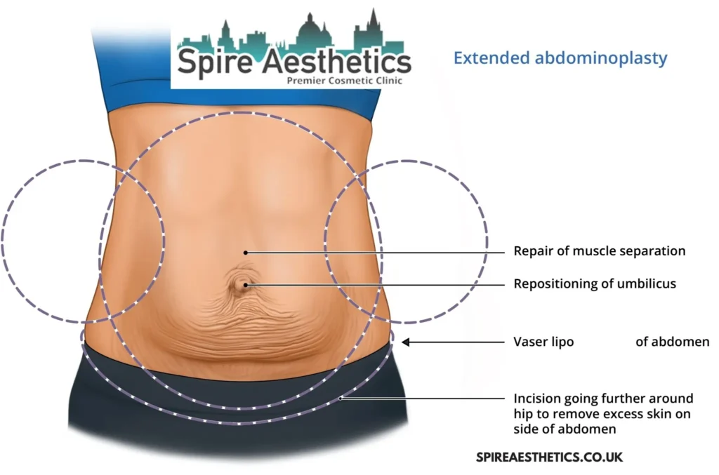 Understanding Loose Skin After Gastric Band Ledbury Surgery and HIFU Treatment