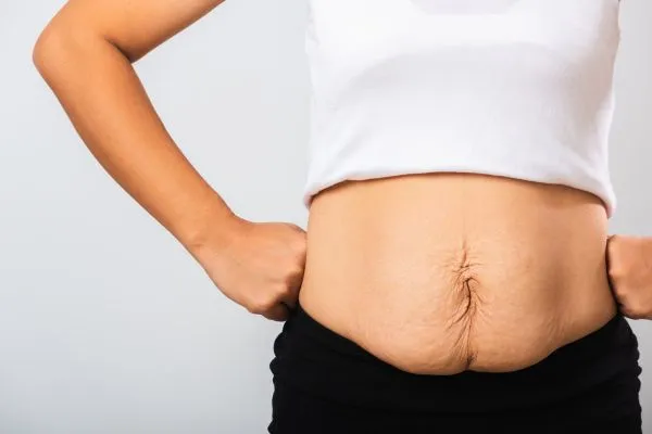 Image of a woman's stomach after weight loss with sagging skin following a gastric band Ledbury