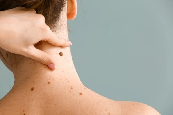 Prices and promotions for blemish removal Ledbury contact our team today!