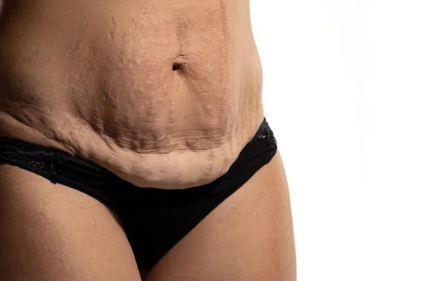 Image of womans stomach after weight loss injections Ledbury showing saggy skin