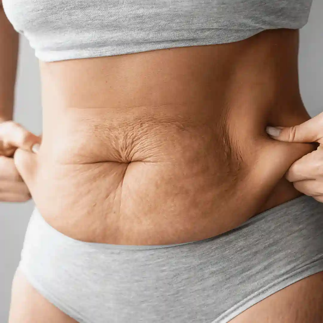 Is It Normal to Have Loose Skin After Pregnancy Ledbury?