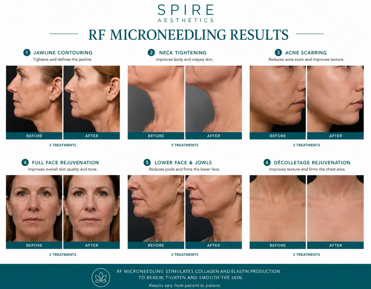 RF Microneedling Skin tightening Ledbury results