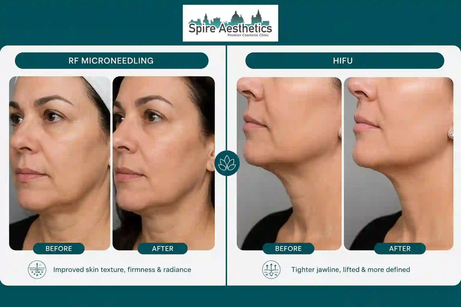 Can RF Microneedling and HIFU Be Combined Ledbury?