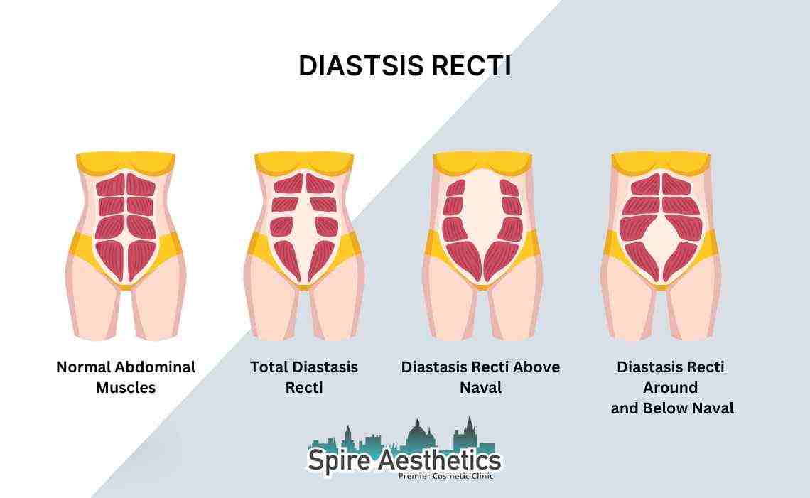 Is Non-Surgical Diastasis Recti Treatment Right for You? Common Concerns Answered Ledbury